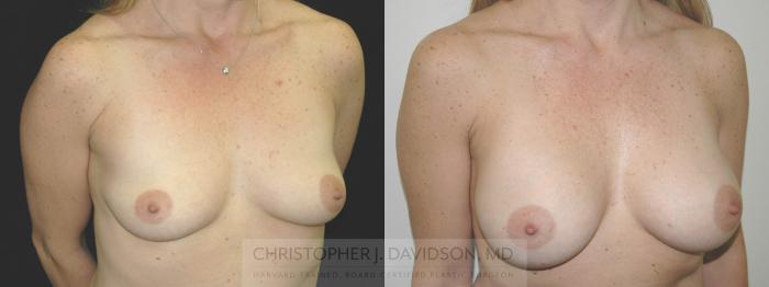 Breast Augmentation Case 224 Before & After View #2 | Boston, MA | Christopher J. Davidson, MD