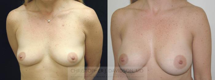 Breast Augmentation Case 224 Before & After View #3 | Boston, MA | Christopher J. Davidson, MD