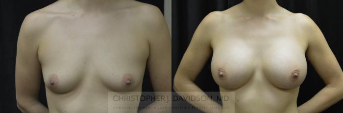 Breast Augmentation Case 228 Before & After View #1 | Boston, MA | Christopher J. Davidson, MD