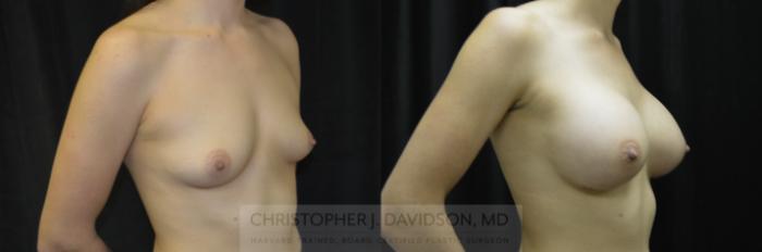 Breast Augmentation Case 228 Before & After View #2 | Boston, MA | Christopher J. Davidson, MD