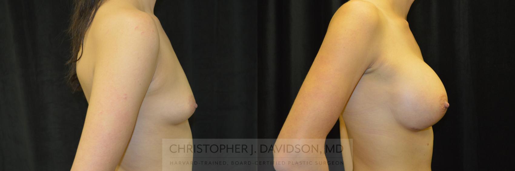 Breast Augmentation Case 228 Before & After View #3 | Wellesley, MA | Christopher J. Davidson, MD