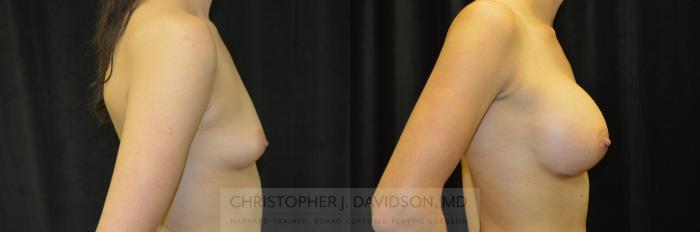 Breast Augmentation Case 228 Before & After View #3 | Boston, MA | Christopher J. Davidson, MD
