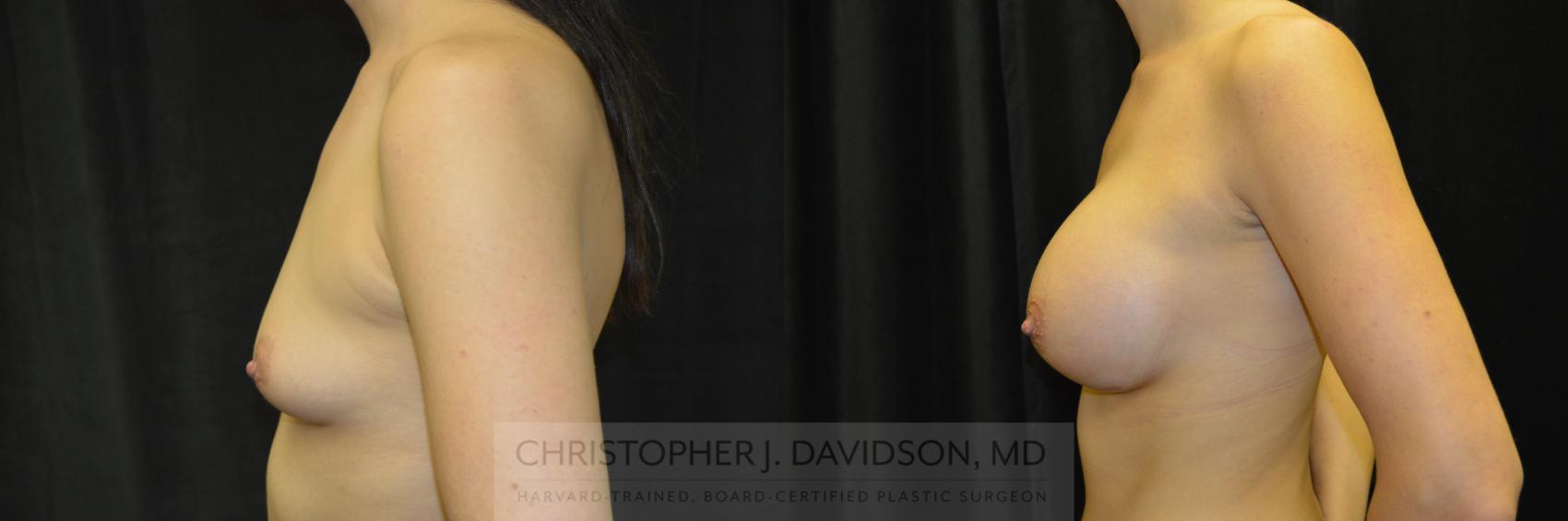 Breast Augmentation Case 228 Before & After View #5 | Wellesley, MA | Christopher J. Davidson, MD
