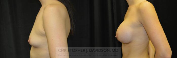 Breast Augmentation Case 228 Before & After View #5 | Boston, MA | Christopher J. Davidson, MD