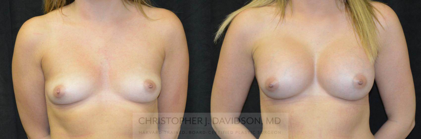 Breast Augmentation Case 240 Before & After View #1 | Wellesley, MA | Christopher J. Davidson, MD