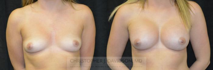 Breast Augmentation Case 240 Before & After View #1 | Boston, MA | Christopher J. Davidson, MD