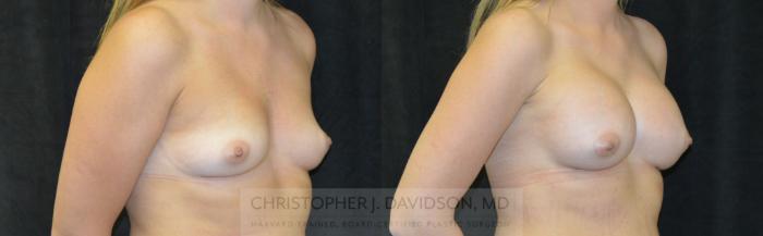 Breast Augmentation Case 240 Before & After View #2 | Boston, MA | Christopher J. Davidson, MD