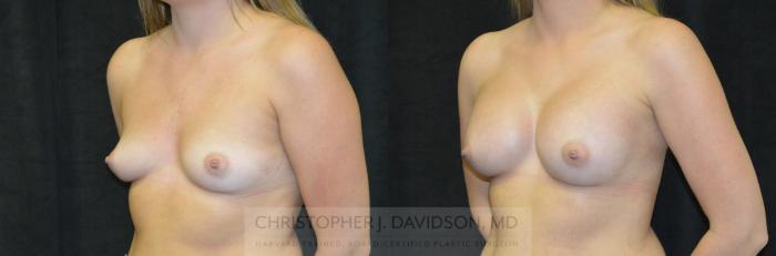 Breast Augmentation Case 240 Before & After View #4 | Boston, MA | Christopher J. Davidson, MD
