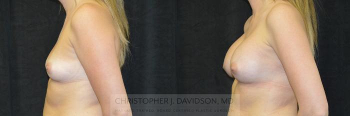 Breast Augmentation Case 240 Before & After View #5 | Boston, MA | Christopher J. Davidson, MD