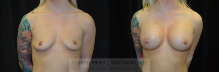 Breast Augmentation Case 241 Before & After View #1 | Boston, MA | Christopher J. Davidson, MD