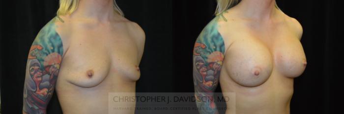 Breast Augmentation Case 241 Before & After View #2 | Boston, MA | Christopher J. Davidson, MD