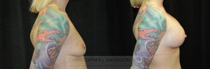 Breast Augmentation Case 241 Before & After View #3 | Boston, MA | Christopher J. Davidson, MD