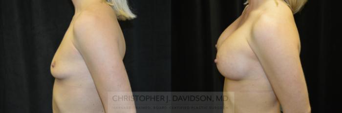 Breast Augmentation Case 241 Before & After View #5 | Boston, MA | Christopher J. Davidson, MD