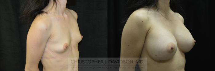 Breast Augmentation Case 242 Before & After View #2 | Boston, MA | Christopher J. Davidson, MD