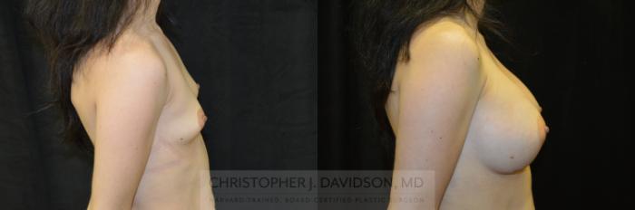 Breast Augmentation Case 242 Before & After View #3 | Boston, MA | Christopher J. Davidson, MD