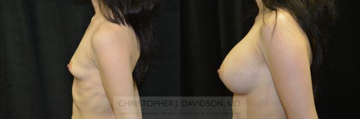 Breast Augmentation Case 242 Before & After View #5 | Boston, MA | Christopher J. Davidson, MD