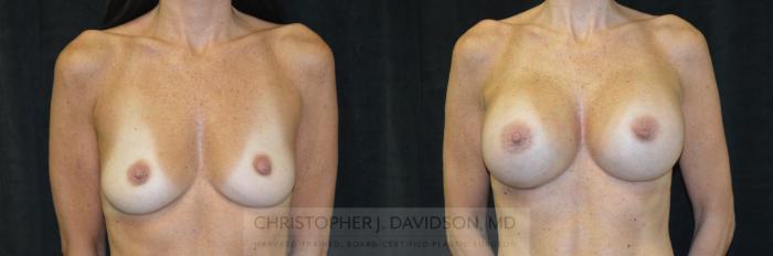 Breast Augmentation Case 243 Before & After View #1 | Boston, MA | Christopher J. Davidson, MD