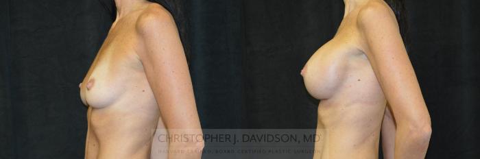 Breast Augmentation Case 243 Before & After View #5 | Boston, MA | Christopher J. Davidson, MD