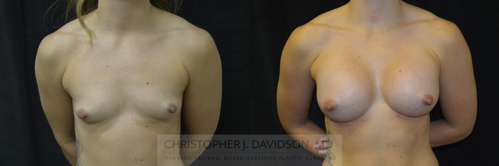Breast Augmentation Case 244 Before & After View #1 | Wellesley, MA | Christopher J. Davidson, MD