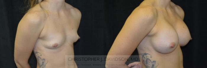 Breast Augmentation Case 244 Before & After View #2 | Boston, MA | Christopher J. Davidson, MD