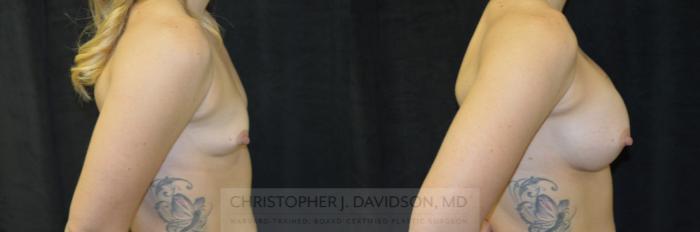 Breast Augmentation Case 244 Before & After View #3 | Boston, MA | Christopher J. Davidson, MD