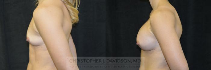 Breast Augmentation Case 244 Before & After View #5 | Boston, MA | Christopher J. Davidson, MD