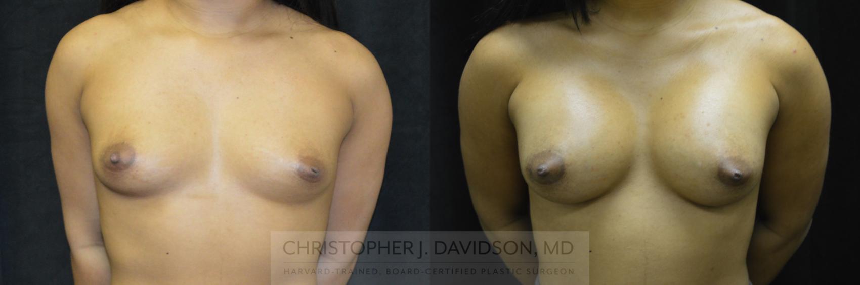 Breast Augmentation Case 245 Before & After View #1 | Wellesley, MA | Christopher J. Davidson, MD