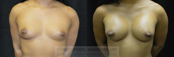 Breast Augmentation Case 245 Before & After View #1 | Boston, MA | Christopher J. Davidson, MD