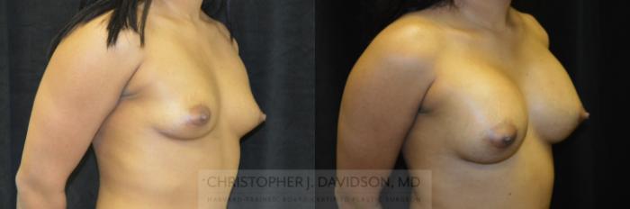 Breast Augmentation Case 245 Before & After View #2 | Boston, MA | Christopher J. Davidson, MD