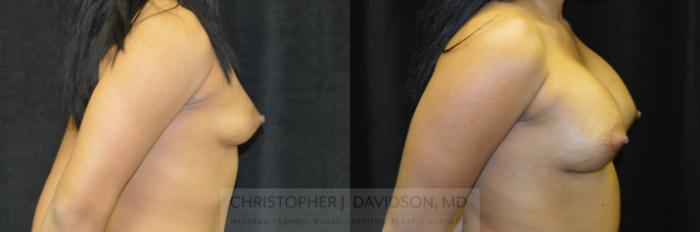 Breast Augmentation Case 245 Before & After View #3 | Boston, MA | Christopher J. Davidson, MD