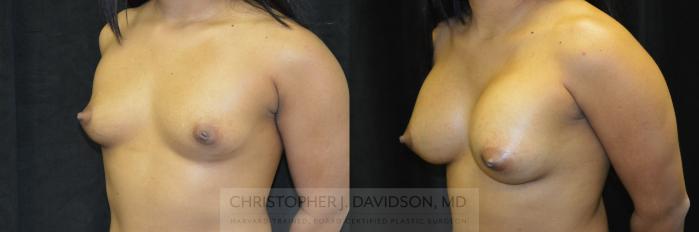 Breast Augmentation Case 245 Before & After View #4 | Boston, MA | Christopher J. Davidson, MD