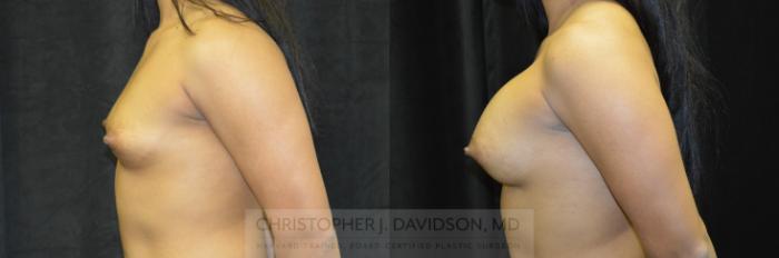 Breast Augmentation Case 245 Before & After View #5 | Boston, MA | Christopher J. Davidson, MD