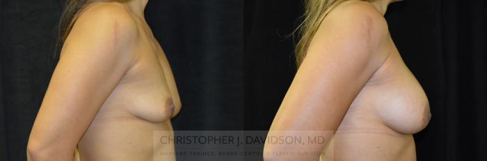 Breast Augmentation Case 247 Before & After View #3 | Boston, MA | Christopher J. Davidson, MD