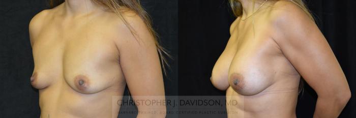 Breast Augmentation Case 247 Before & After View #4 | Boston, MA | Christopher J. Davidson, MD