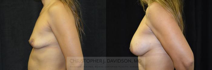 Breast Augmentation Case 247 Before & After View #5 | Boston, MA | Christopher J. Davidson, MD