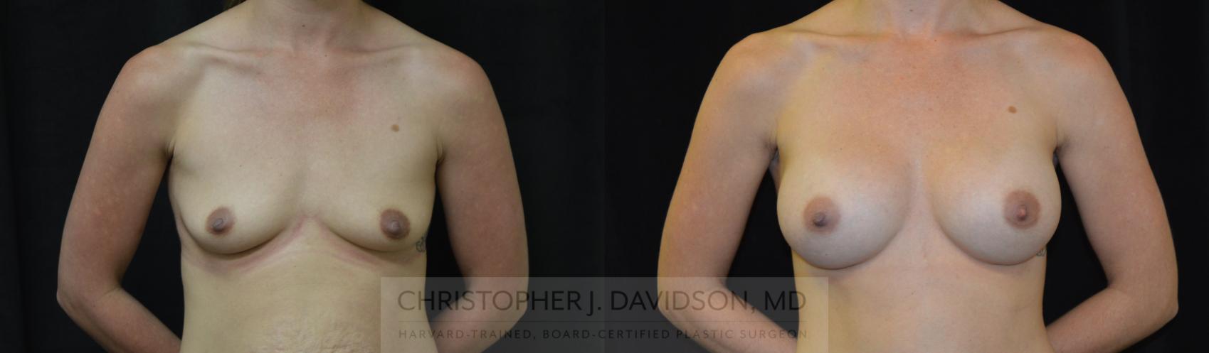 Breast Augmentation Case 257 Before & After Front | Boston, MA | Christopher J. Davidson, MD