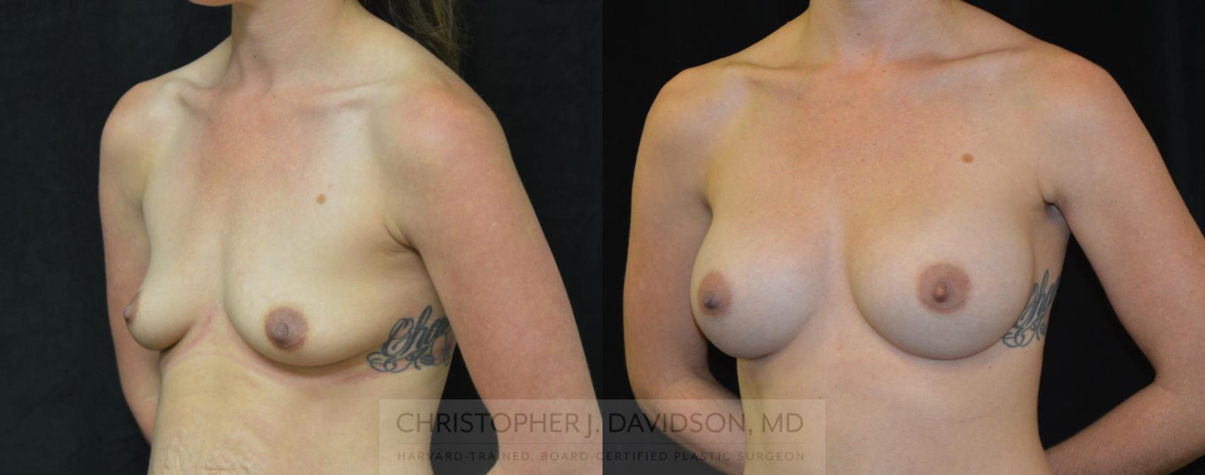 Breast Augmentation Case 257 Before & After Left Oblique | Wellesley, MA | Christopher J. Davidson, MD