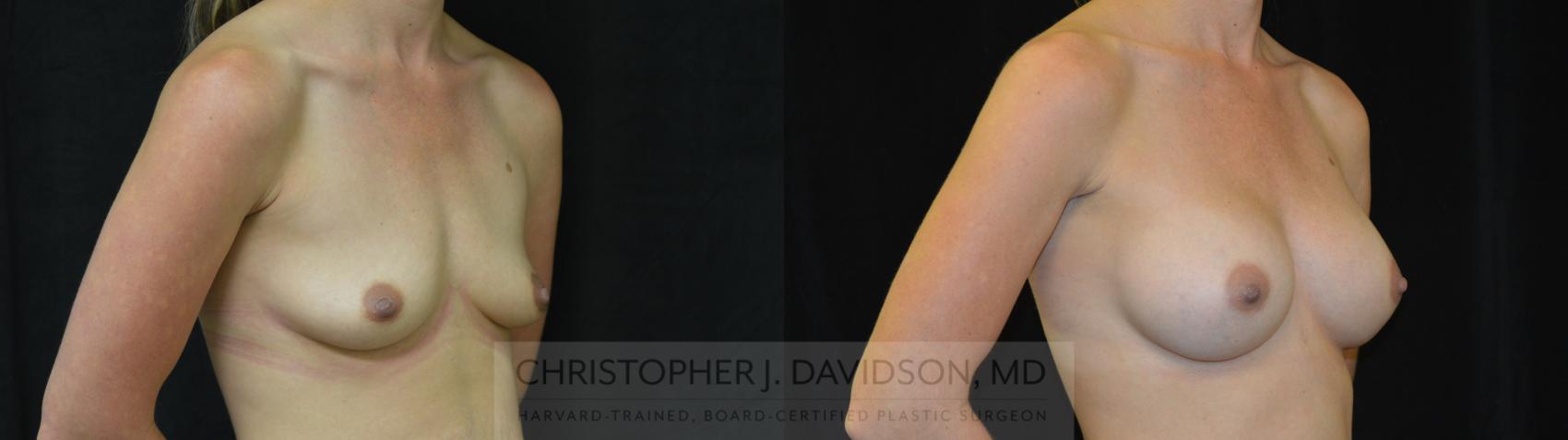 Breast Augmentation Case 257 Before & After Right Oblique | Wellesley, MA | Christopher J. Davidson, MD