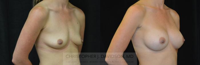 Breast Augmentation Case 257 Before & After Right Oblique | Boston, MA | Christopher J. Davidson, MD