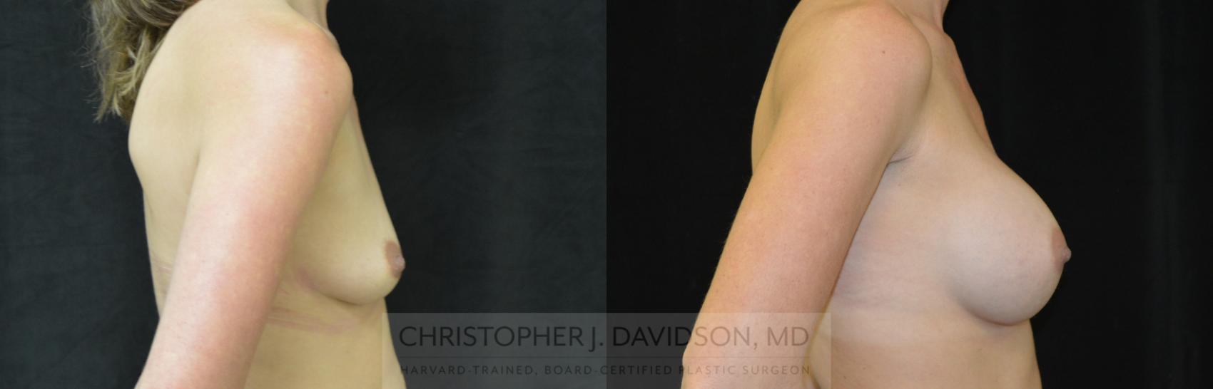 Breast Augmentation Case 257 Before & After Right Side | Wellesley, MA | Christopher J. Davidson, MD