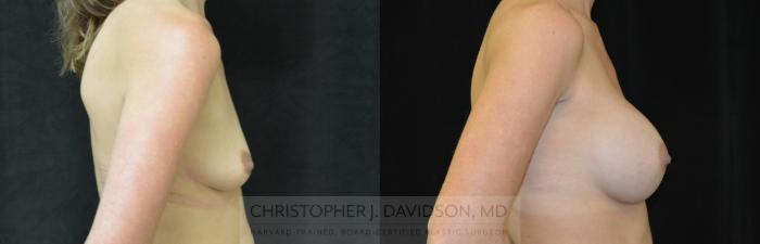 Breast Augmentation Case 257 Before & After Right Side | Boston, MA | Christopher J. Davidson, MD