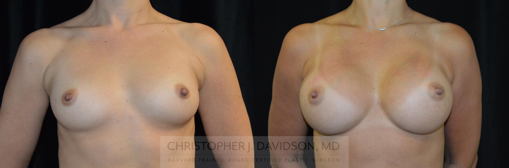 Breast Augmentation Case 260 Before & After Front | Boston, MA | Christopher J. Davidson, MD