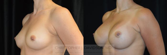 Breast Augmentation Case 260 Before & After Left Oblique | Boston, MA | Christopher J. Davidson, MD