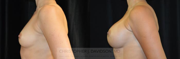 Breast Augmentation Case 260 Before & After Left Side | Boston, MA | Christopher J. Davidson, MD
