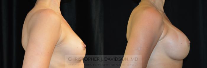 Breast Augmentation Case 260 Before & After Right Side | Boston, MA | Christopher J. Davidson, MD