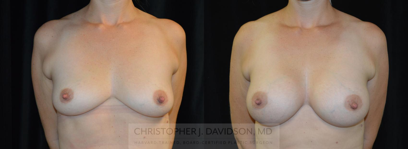 Breast Augmentation Case 265 Before & After Front | Wellesley, MA | Christopher J. Davidson, MD