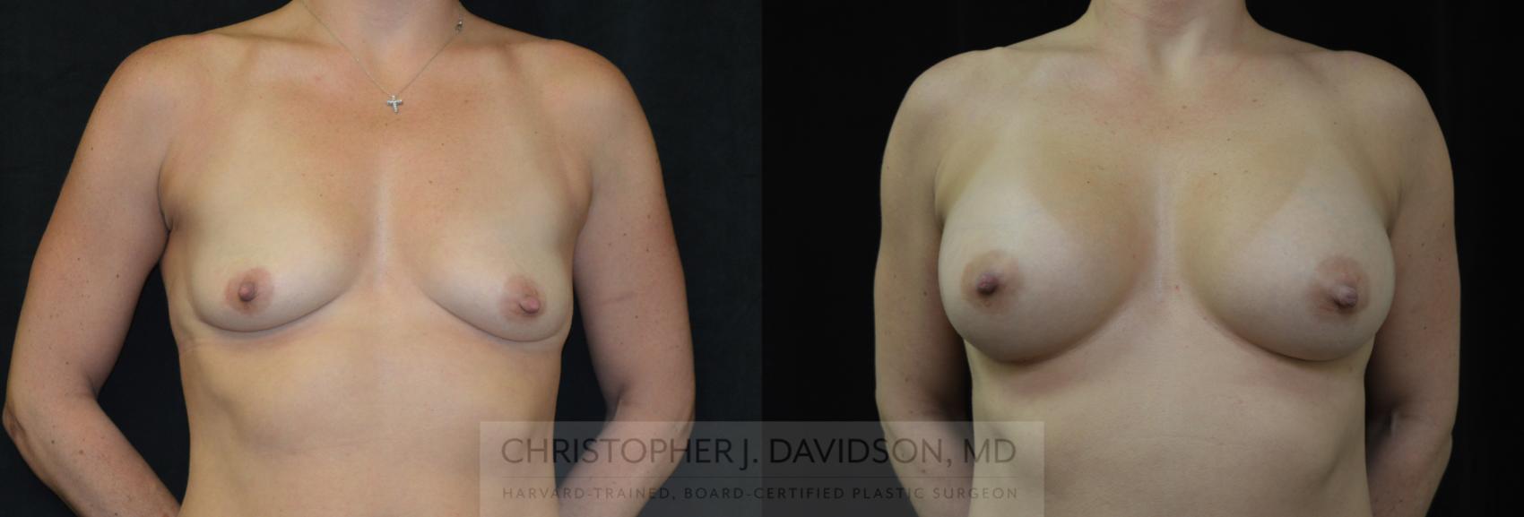 Breast Augmentation Case 267 Before & After Front | Boston, MA | Christopher J. Davidson, MD