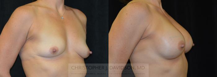Breast Augmentation Case 267 Before & After Left Oblique | Boston, MA | Christopher J. Davidson, MD