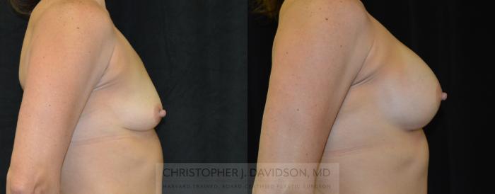 Breast Augmentation Case 267 Before & After Left Side | Boston, MA | Christopher J. Davidson, MD