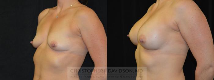 Breast Augmentation Case 267 Before & After Right Oblique | Boston, MA | Christopher J. Davidson, MD
